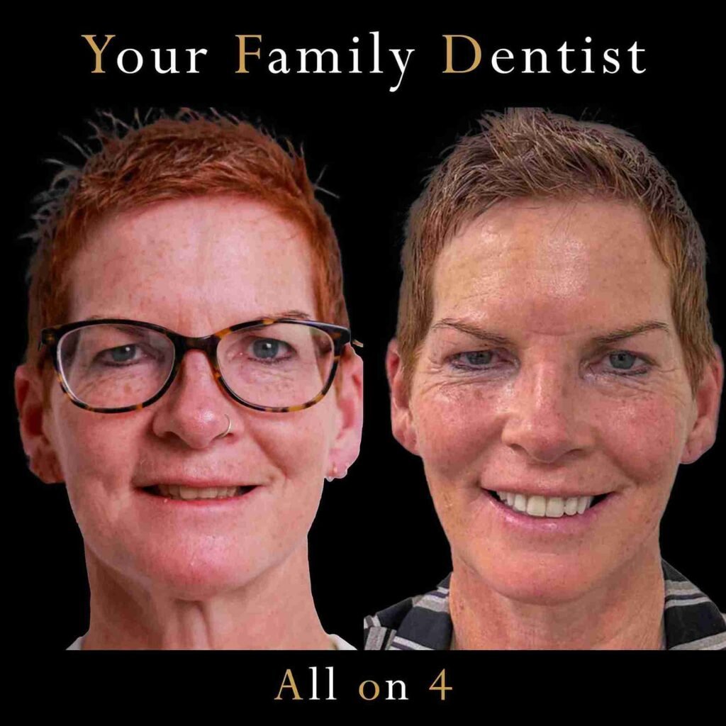 All on x dental implant