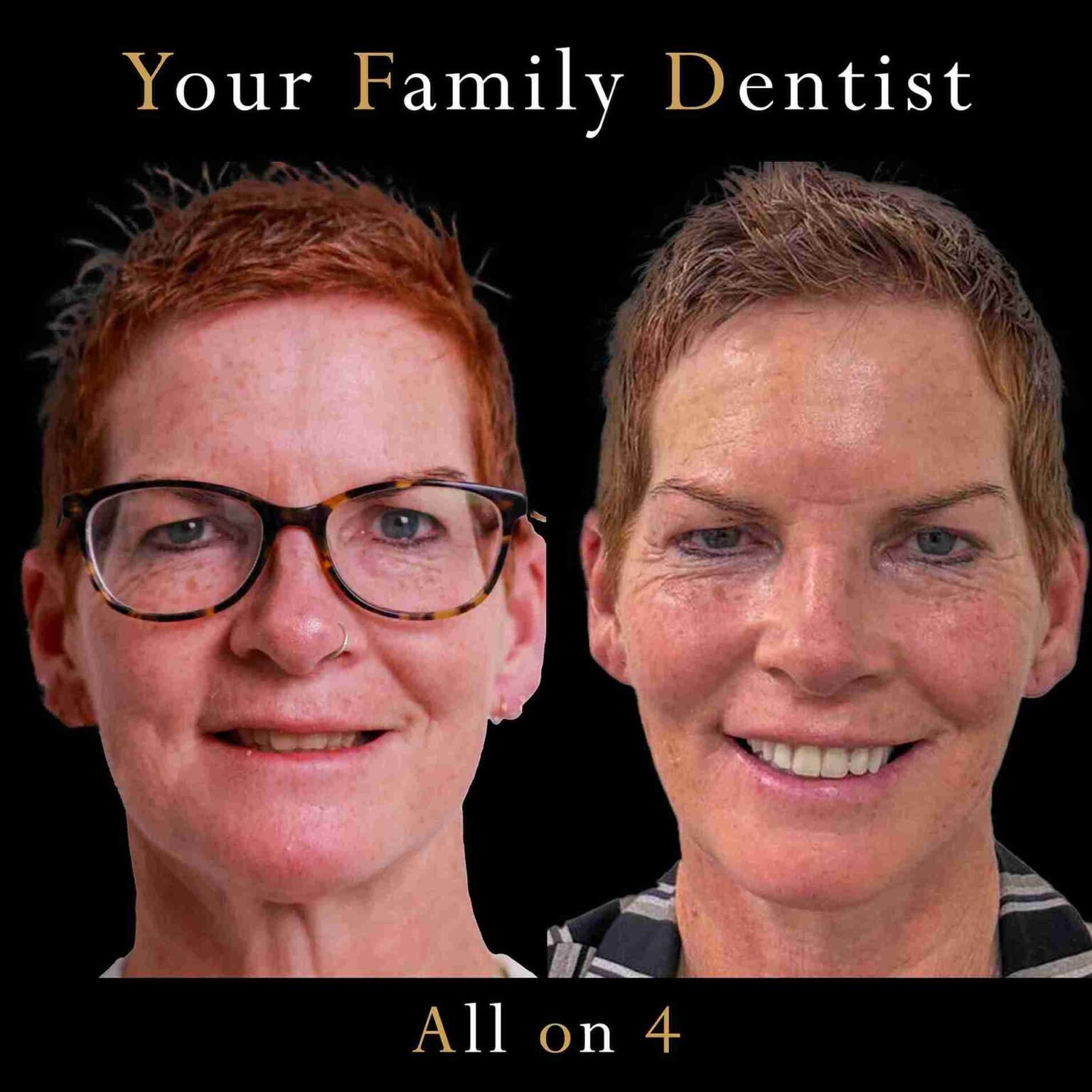 Dentist reviewing X-rays for clip-on denture treatment