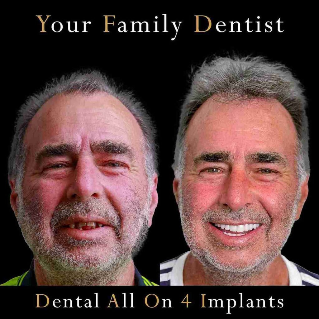 Dental Implant