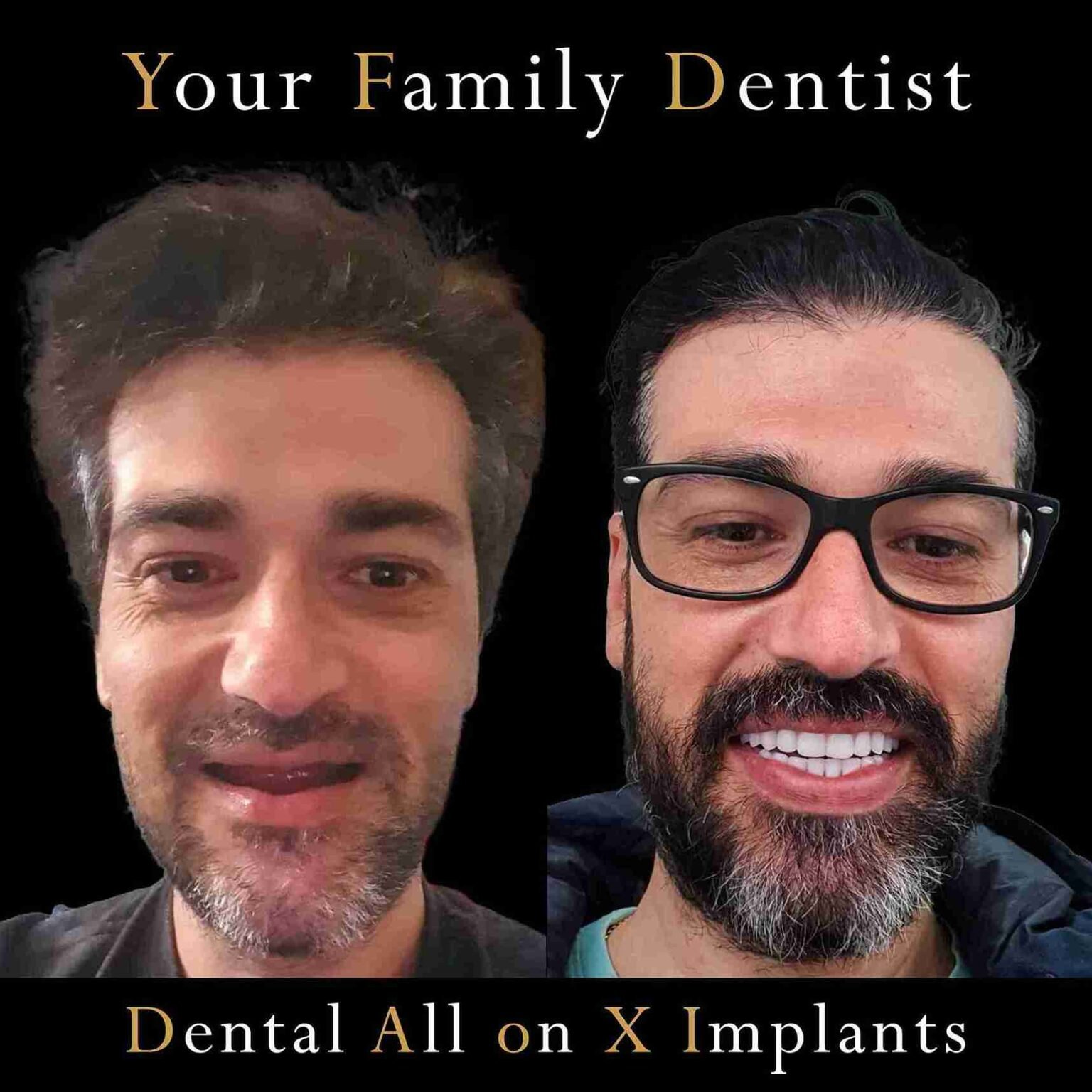 Before and after smile transformation at Your Family Dentist