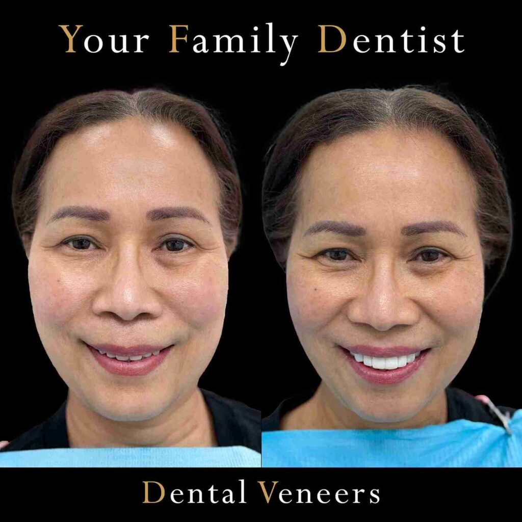 Dental Implant All on X