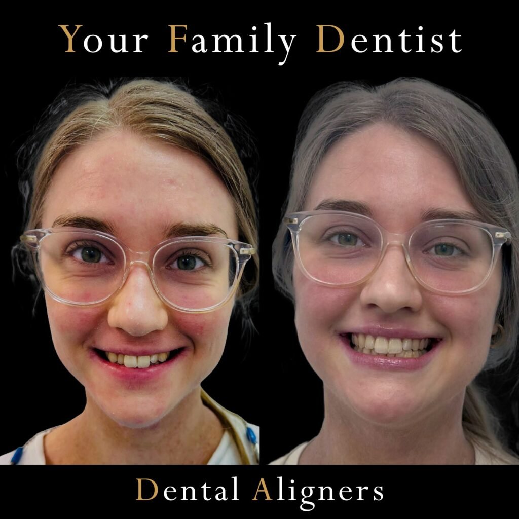 Dental Aligners