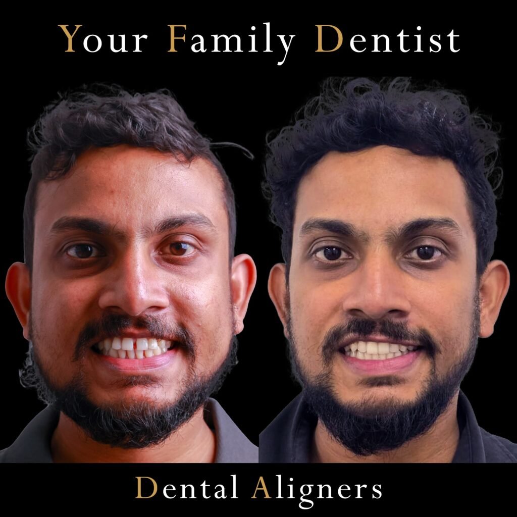 Aligners 2