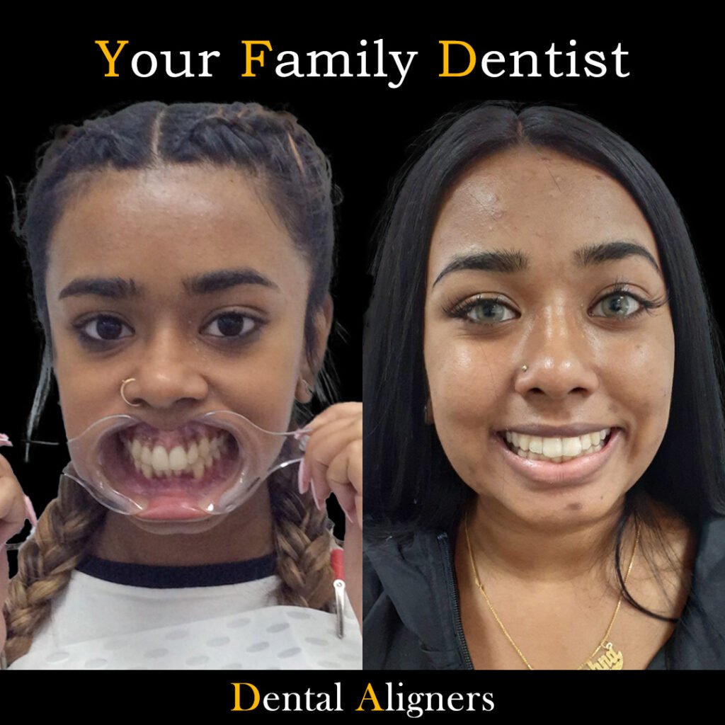 Dental Aligners