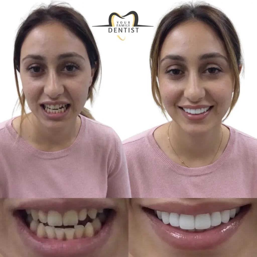 digital smile designing with dental veneers 11