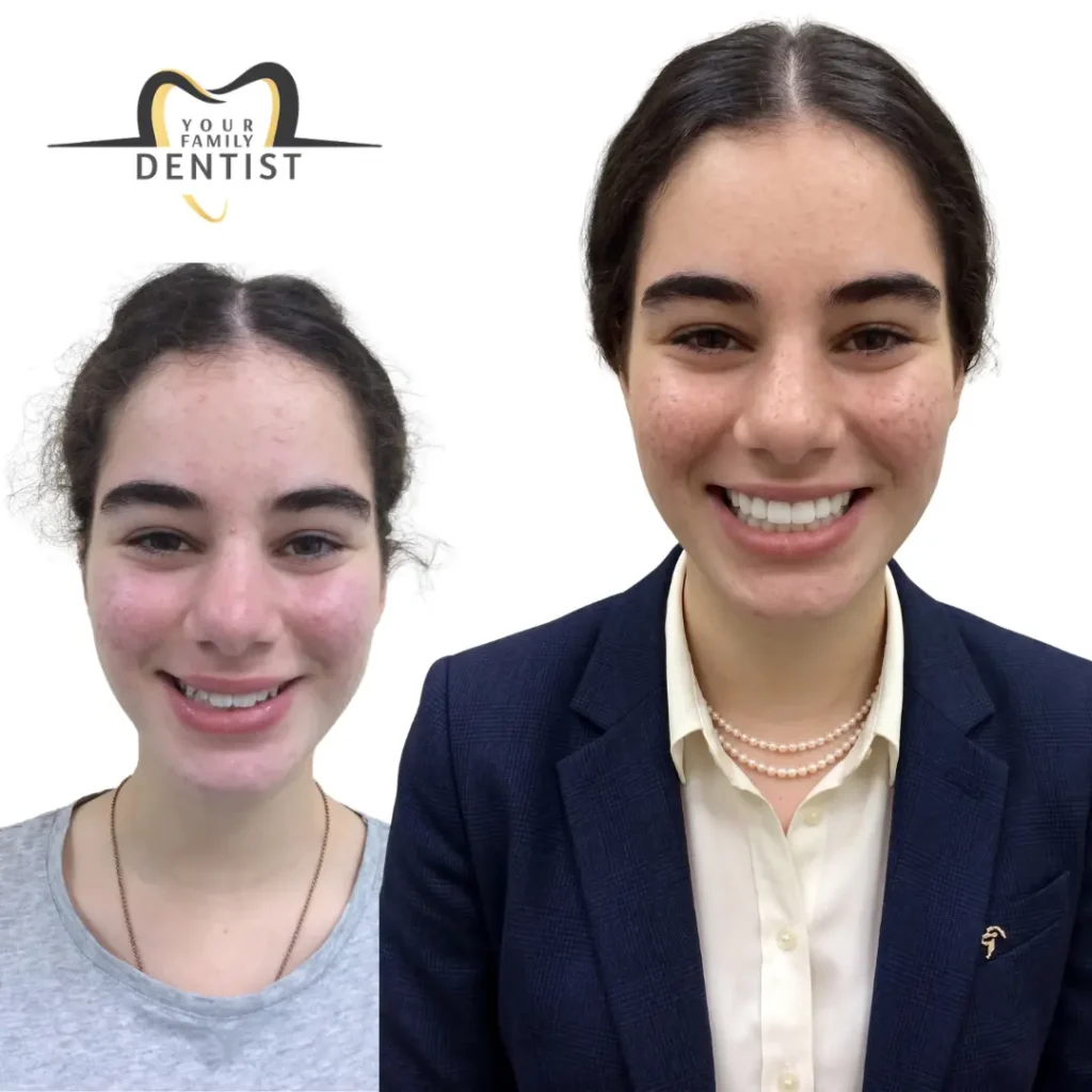 digital smile designing with dental veneers 18