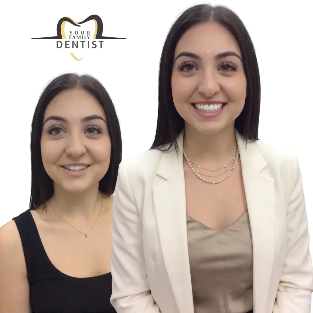 digital smile designing with dental veneers 20