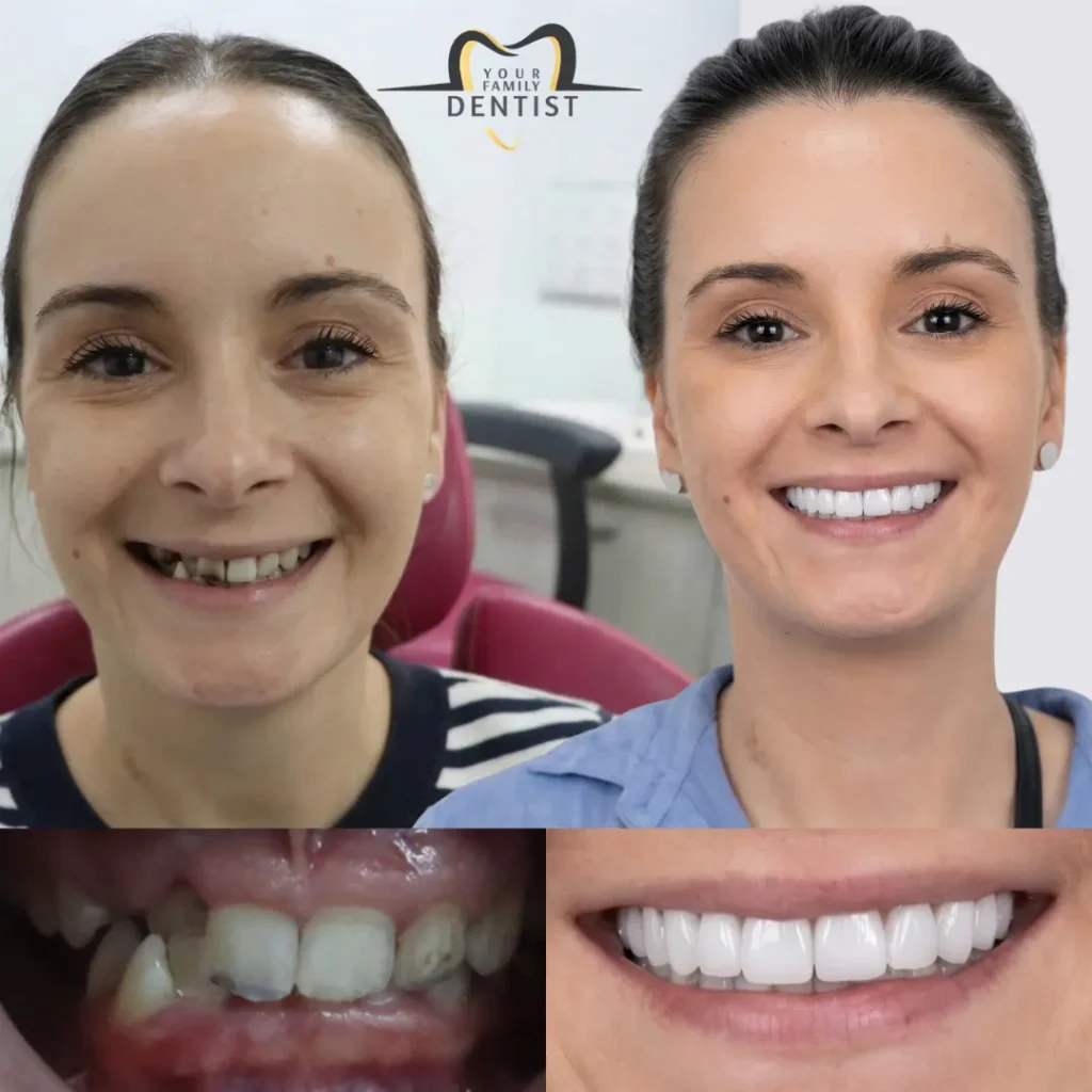 digital smile designing with dental veneers 8