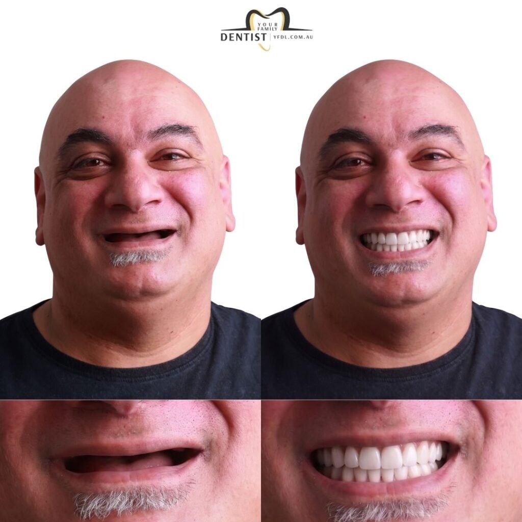 Dental All on X