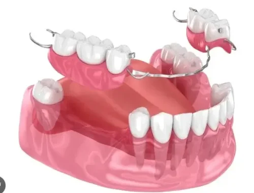 Partial Dentures fills the gaps to restore your smile